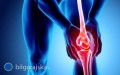Bl kolana (stawu kolanowego) - objawy, leczenie i profilaktyka